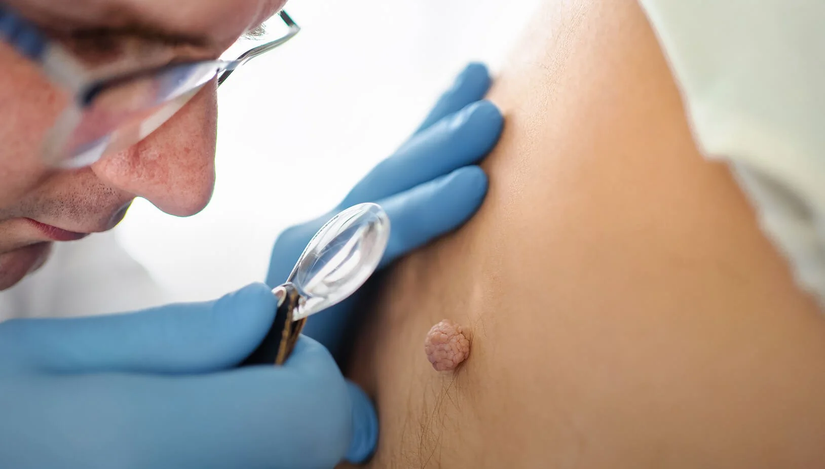 When should you consider removing a skin growth?