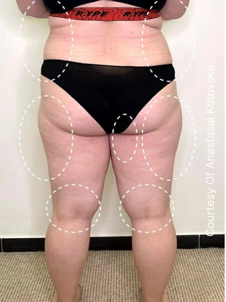Cellulite treatment in action before results