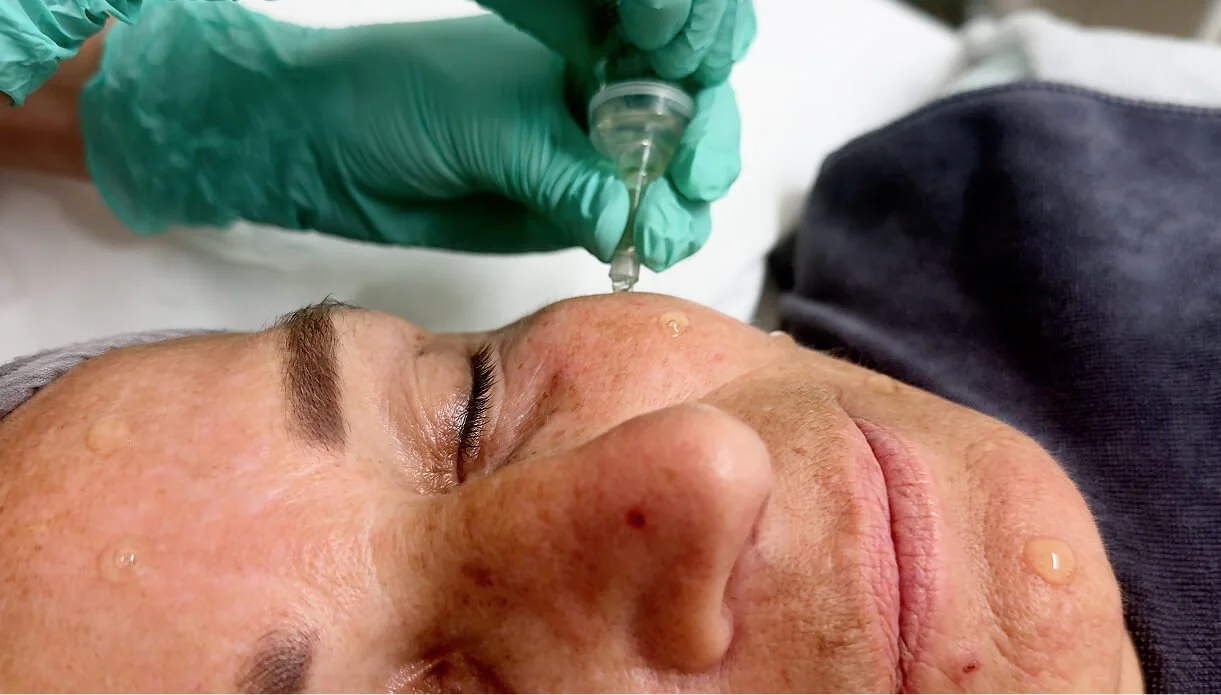 Is PQAge Evolution Peel Similar to PRP?