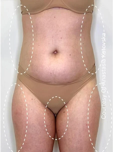 Cellulite treatment in action after results