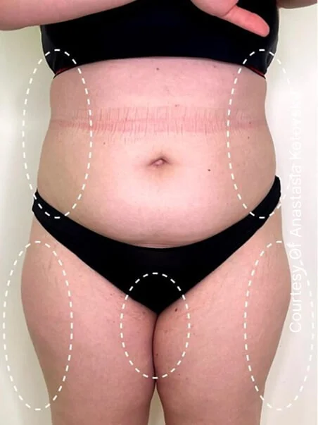 Cellulite treatment in action before results