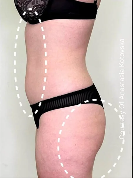 Cellulite treatment in action after results