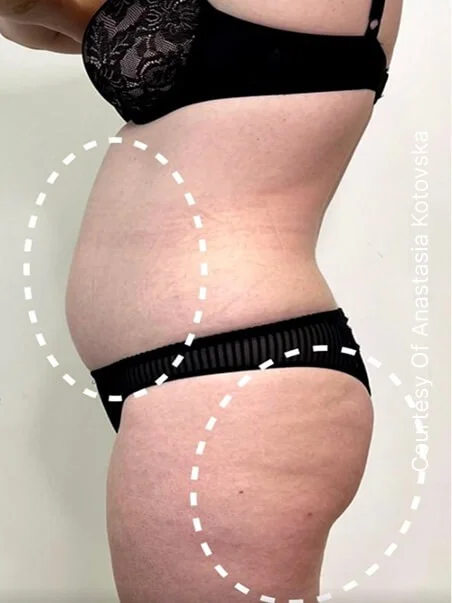 Cellulite treatment in action before results