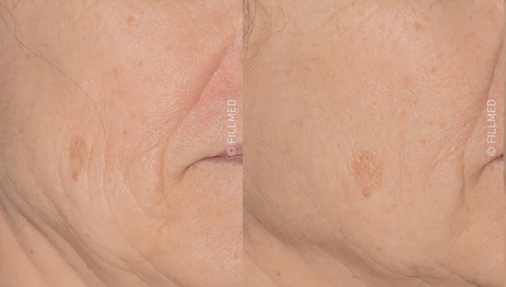 Before and after results of NCTF 135 HA skin revitalisation treatment showing reduction in fine lines and improved skin texture