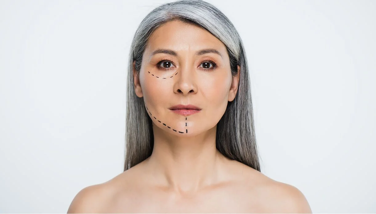 alt="A middle-aged woman with guide lines marked on her lower face and jawline, representing the treatment planning process at rtwskin in Tunbridge Wells."